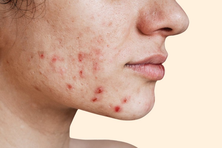 How Ultima Accutane For Sale Should Be Used To Get Results?